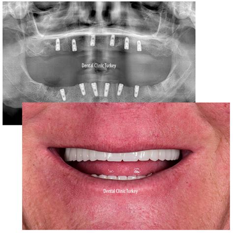 full-mouth implant in kent|No.1 Dental implants in Kent .